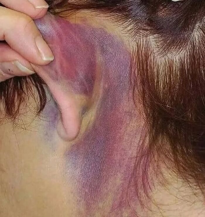 Moretón grande y morado detrás de la oreja, mostrando una condición médica impactante del cuerpo humano.