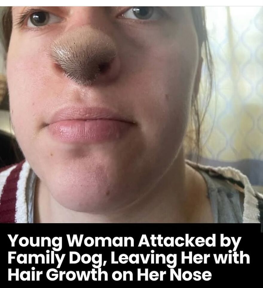 Close-up of young woman with bizarre medical condition showing hair growth on her nose after a dog attack, eerie medical pics.