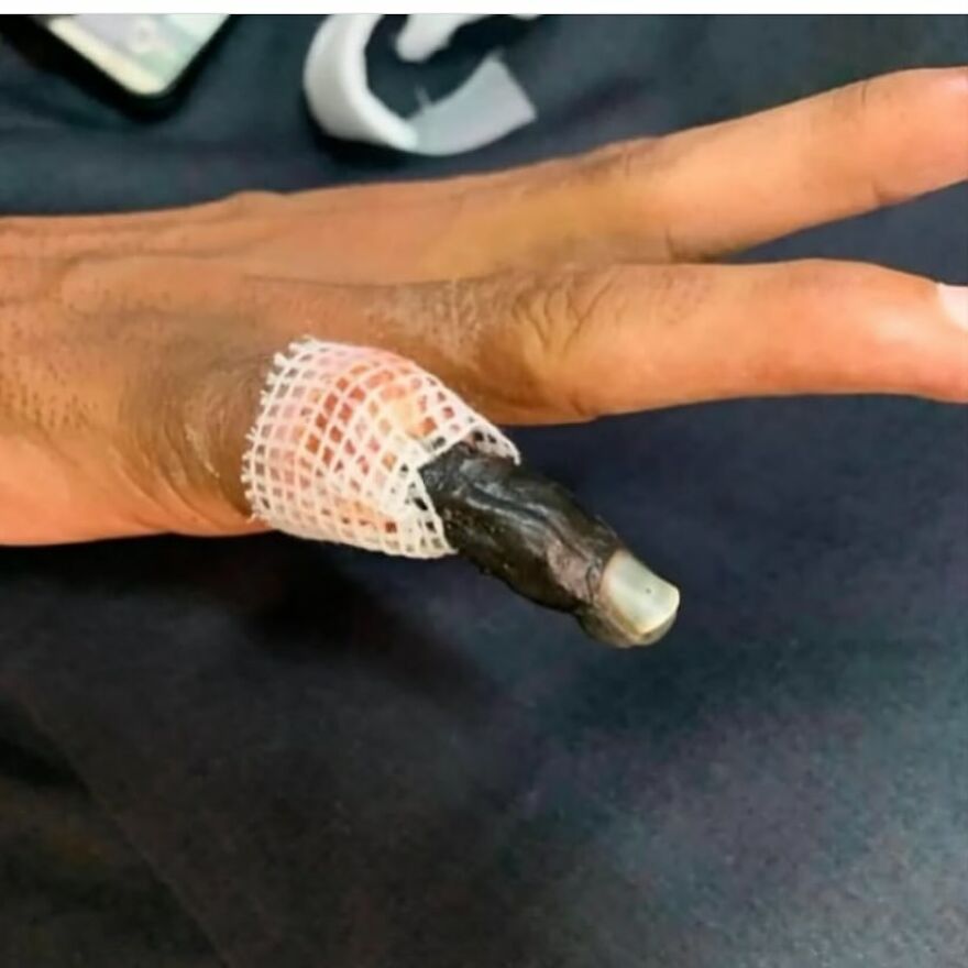 A close-up of a hand with a severely blackened, bandaged finger shown in bizarre medical pics.