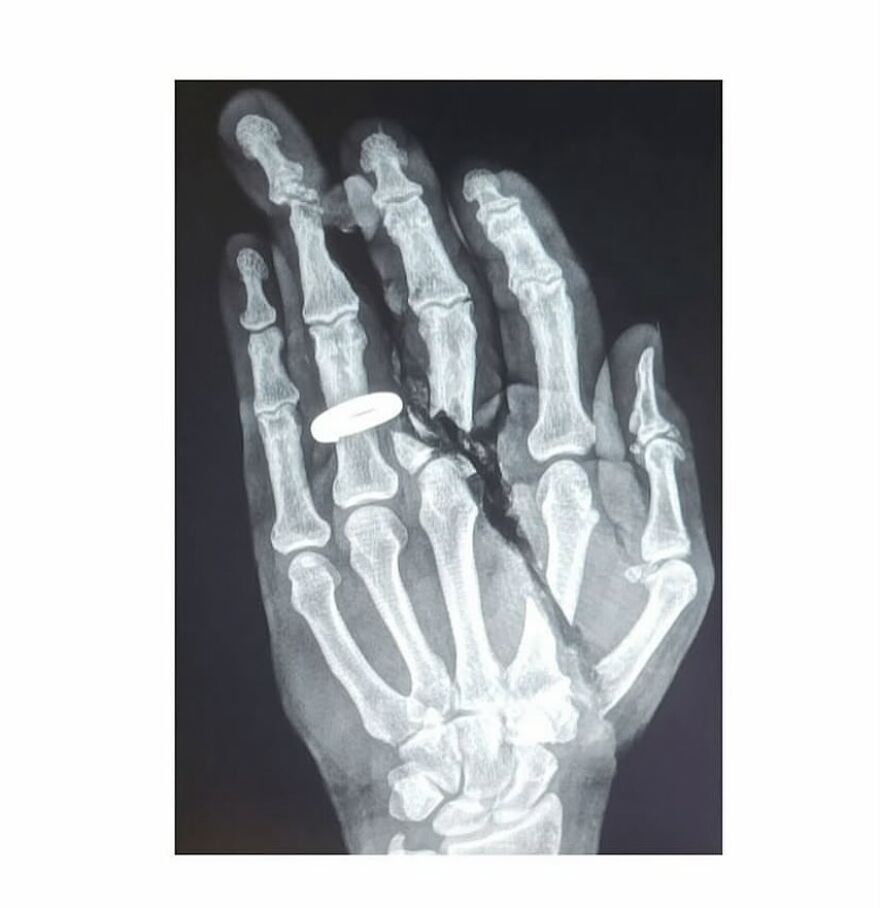 X-ray image of a hand showing bizarre medical condition with finger bone abnormalities and a ring on one finger.