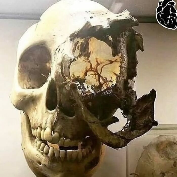 Cráneo humano con parte del hueso destruido, imagen médica que muestra lo aterrador que puede ser el cuerpo humano.