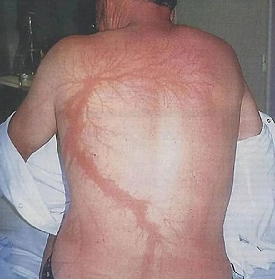 Man with bizarre red marks on his back resembling an eerie branching pattern in a medical condition image.