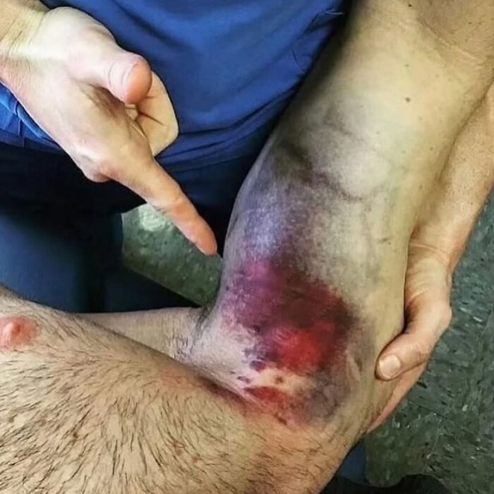 Persona señalando moretón grande y sangrado en el codo, imagen médica que muestra lo aterrador del cuerpo humano.