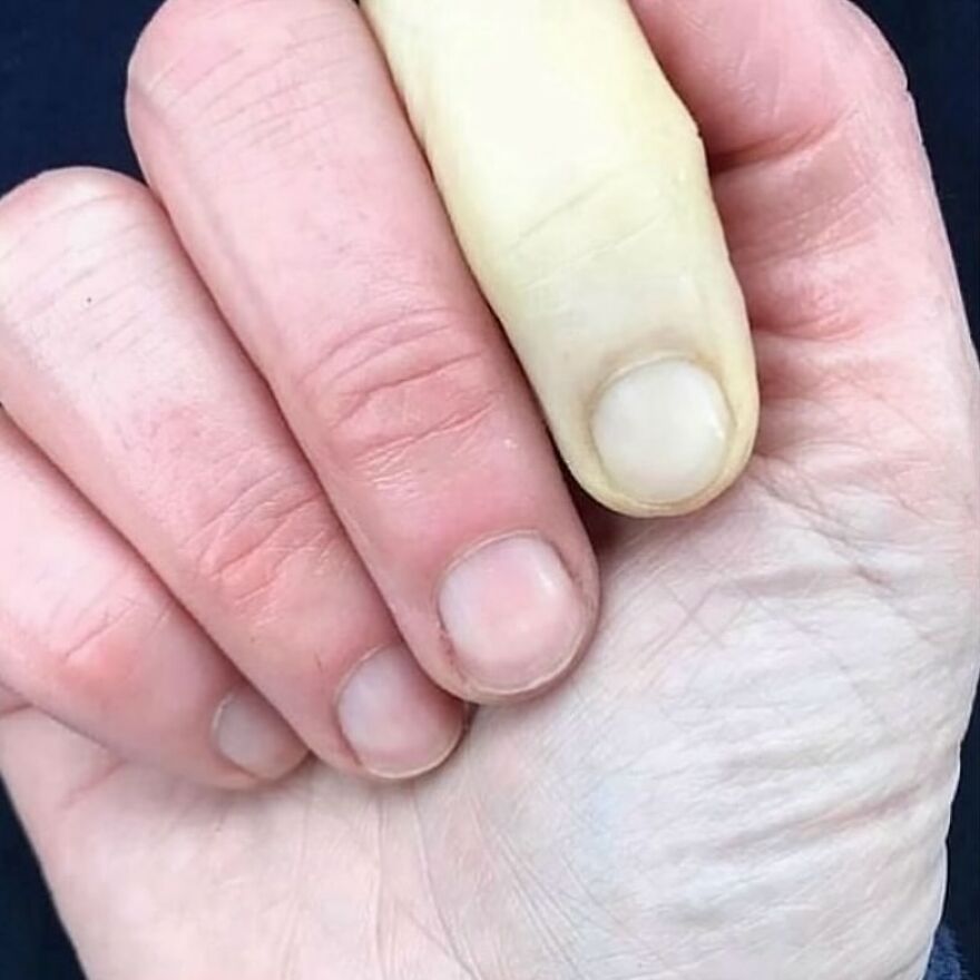 Close-up of hand with one finger showing abnormal yellow discoloration, illustrating bizarre medical condition.