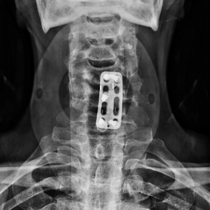Radiografía médica que muestra una placa metálica en la columna vertebral, ejemplificando el cuerpo y su complejidad.