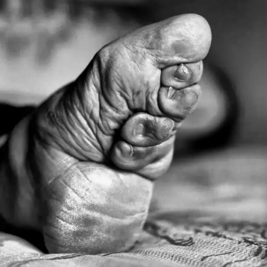 Close-up black and white photo of a wrinkled foot with abnormal toes from bizarre medical pics shared on IG account.