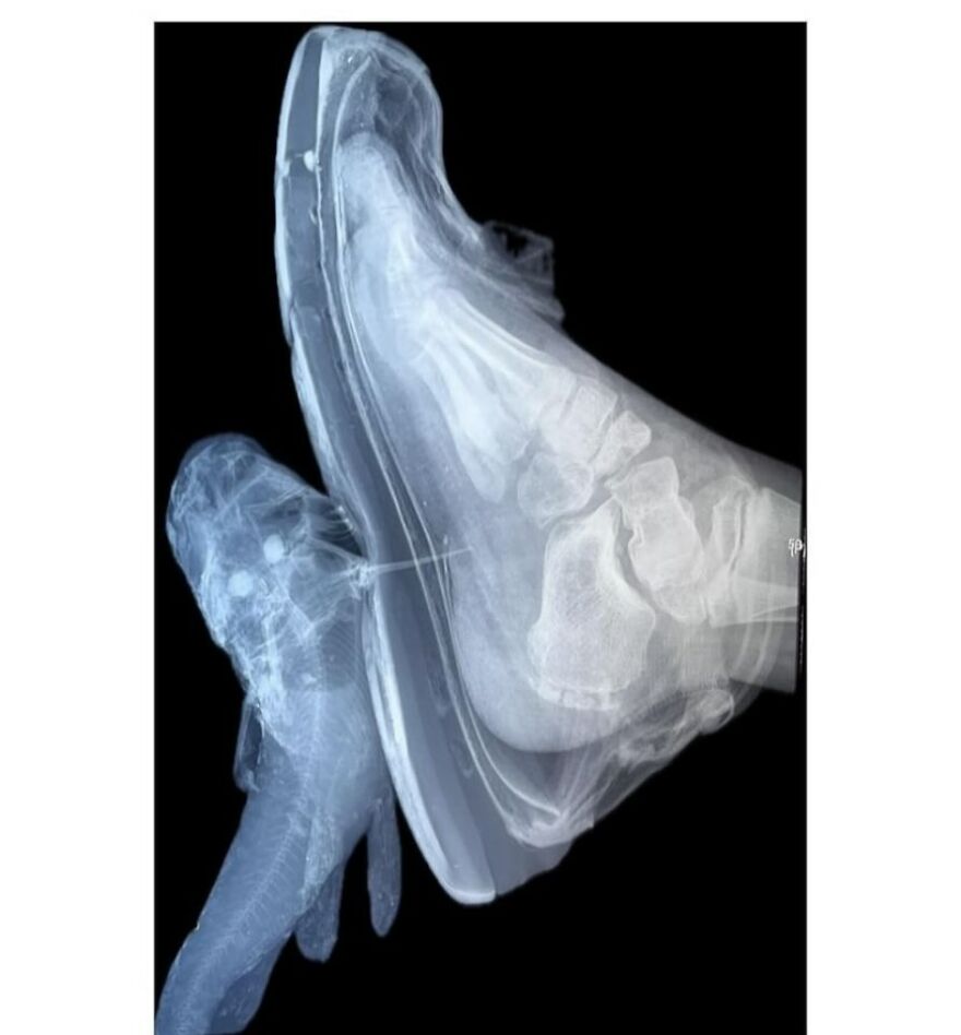 X-ray image showing a foot inside a shoe alongside an unusual fish skeleton, featuring bizarre medical pics.