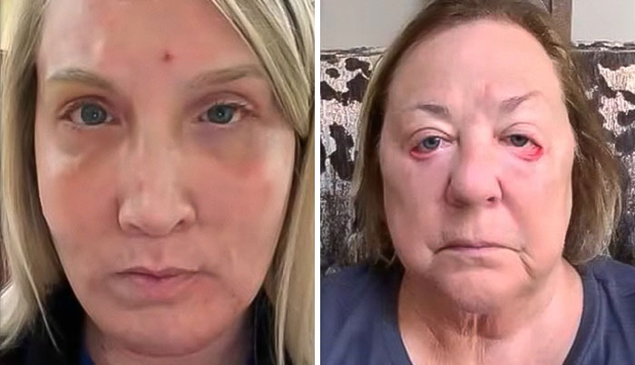 "I Look Worse Than When I Started": Before-And-After Results Of Botched Plastic Surgeries Stun