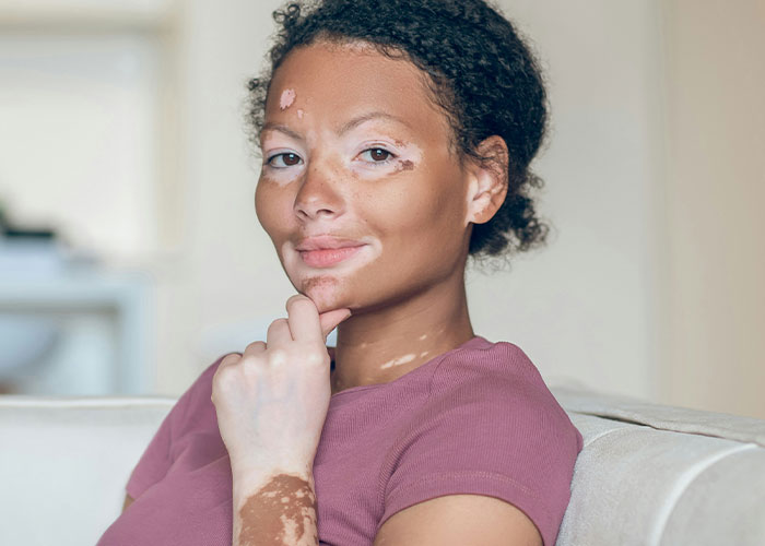 Woman with vitiligo sitting on a couch, representing parents sharing the worst things their kids did in public moments.