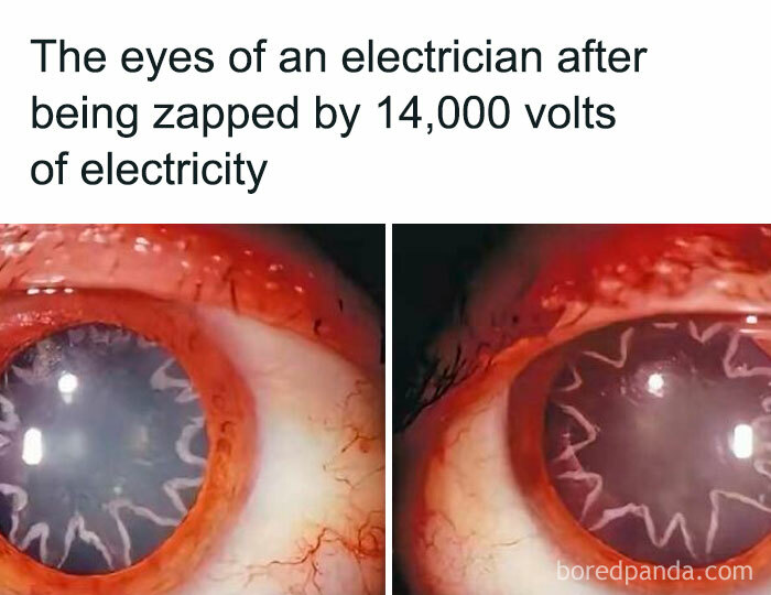 Close-up images of an electrician’s eye showing unusual patterns after being zapped by 14,000 volts of electricity.