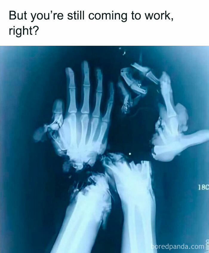 X-ray image of broken hands with text but you’re still coming to work right, silly relatable spicy memes concept.