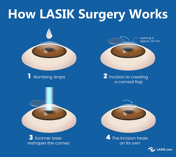 Diagram showing how LASIK surgery works in four steps including numbing drops, corneal flap incision, laser reshaping, and healing incision.