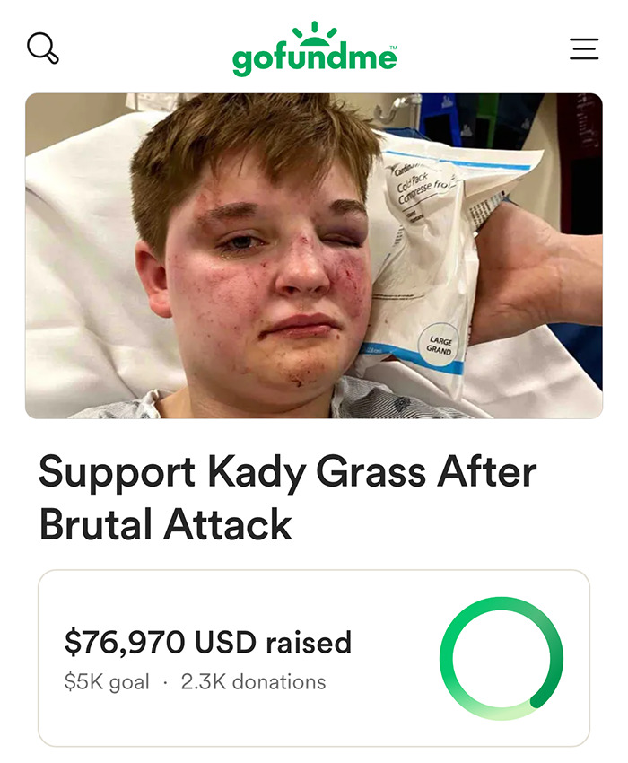 Person with bruised face and black eye in hospital bed, GoFundMe page seeking support after brutal attack on lesbian.