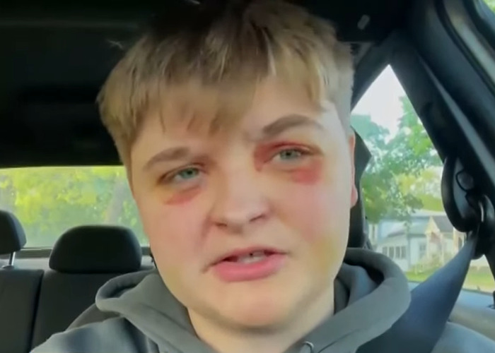 Person with bruised face sitting in a car, sharing a story as a lesbian who was beaten unconscious.