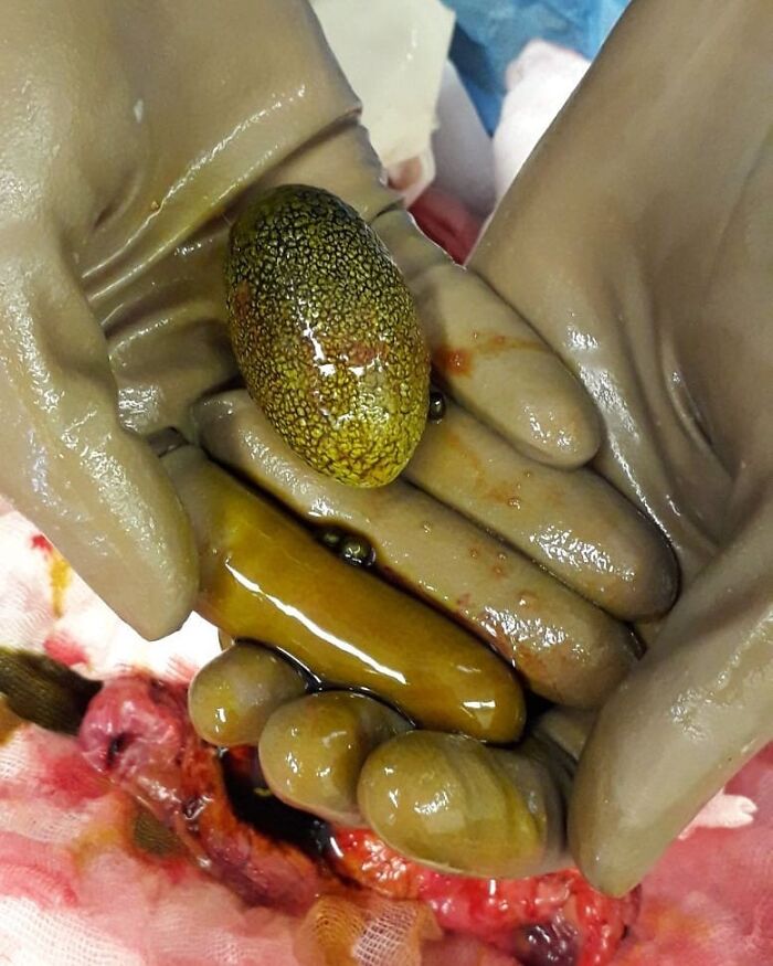Medical gloved hands holding unusual extracted objects during a strange and uncanny medical procedure.
