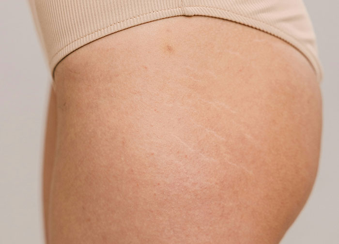 Close-up of skin with stretch marks, illustrating hurtful things doctors said and actions that made patients change doctors.
