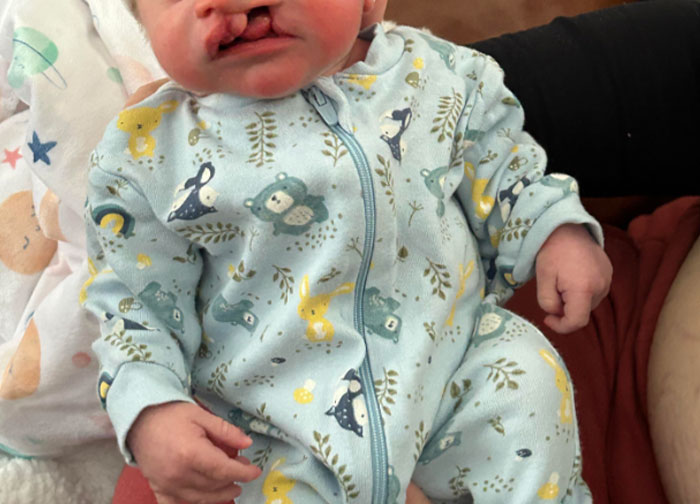 Infant with cleft lip in a patterned onesie, illustrating hurtful things doctors said and made patients seek new doctors.