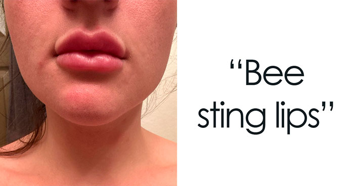 “Bee Sting Lips”: 50 Men Reveal Petty Dealbreakers They Think Women Don’t Notice