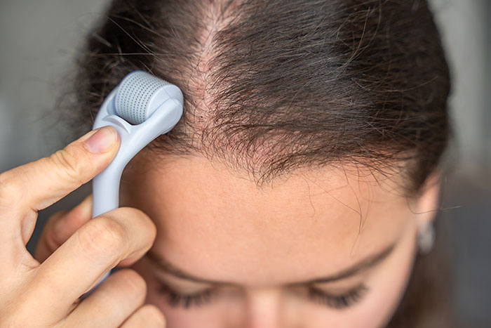 Close-up of woman using a derma roller on her scalp, highlighting alopecia and hair loss treatment concept.