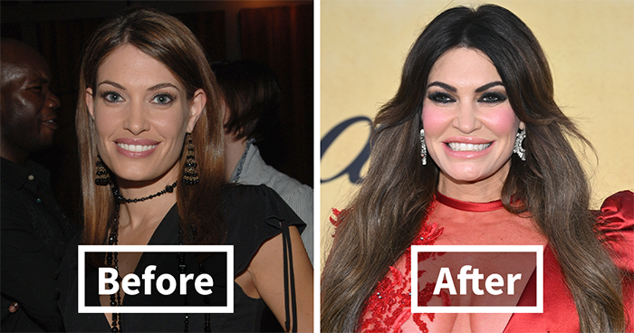 “They Look Worse”: Plastic Surgeons Reveal The Intriguing Secrets Behind The “Mar-a-Lago Face”