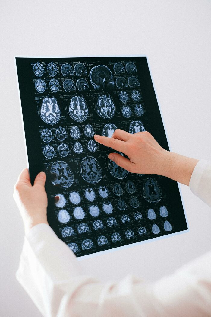 Person holding and pointing at brain MRI scans, illustrating medical analysis related to tinnitus effects on the body.
