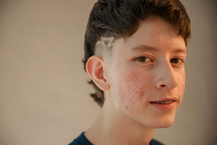 Teenage boy with acne and braces, looking thoughtfully at camera, symbolizing siblings of narcissists and sociopaths.