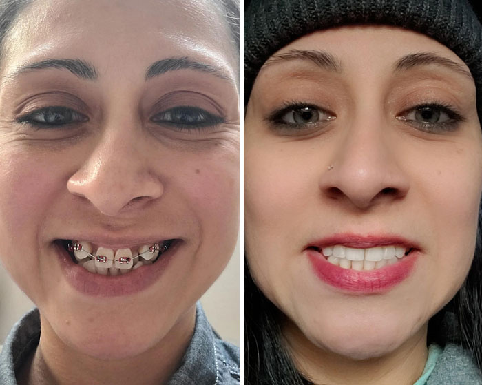 Side-by-side close-up of a woman before and after small appearance changes that made a big difference for her smile.
