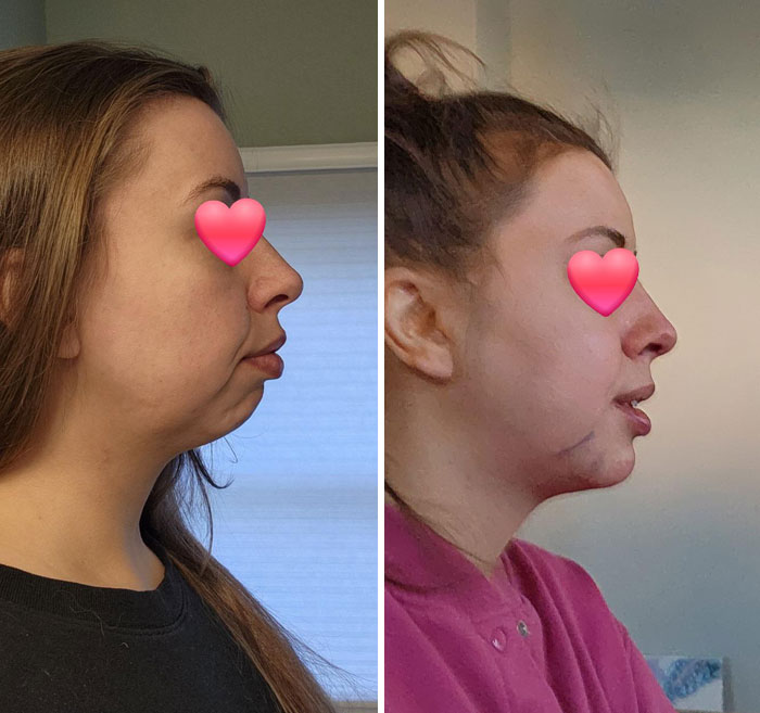 Before and after photos showing small appearance changes on a woman's profile that made a big difference.