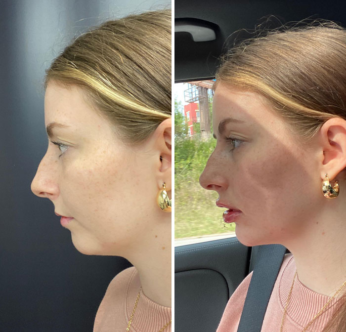 Side-by-side profile of a woman showing small appearance changes that made a big difference for women.