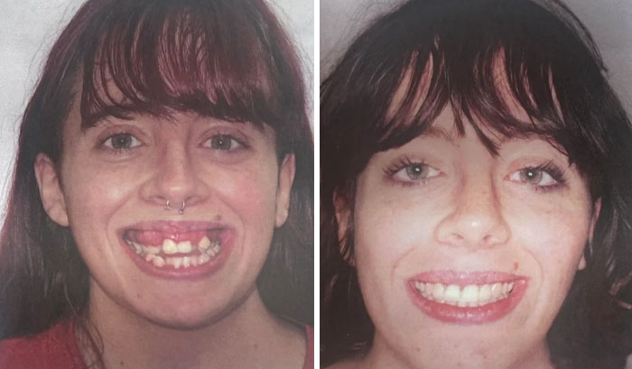 Before and after photos of a woman showing small appearance changes in her smile and teeth that made a big difference.