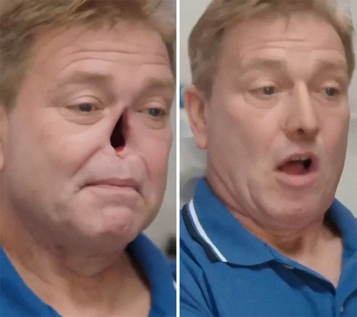 Man shown with a severe nasal injury and facial trauma in a medical case that is both gory and interesting.