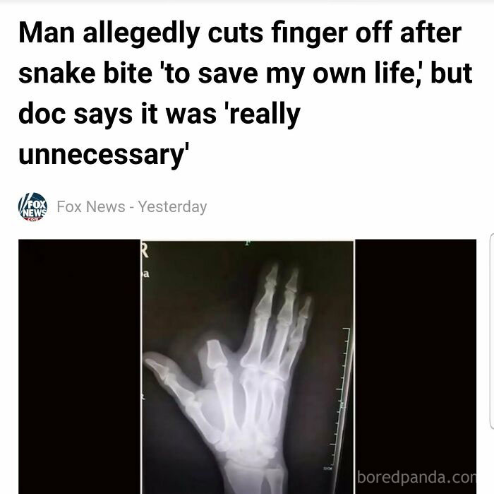 X-ray image of a man’s hand with a finger cut off illustrating men doing dumb things that explain why women live longer