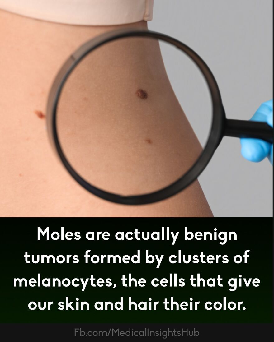 Close-up of skin with moles examined under a magnifying glass, illustrating unique medical facts about the human body.