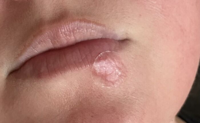 Close-up of a healing skin glitch on the lower lip, illustrating one of 22 genius ways to fix little skin glitches.