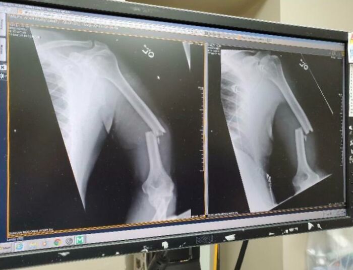 X-ray images showing a fractured human arm bone displayed on a medical monitor, highlighting human body anatomy details.