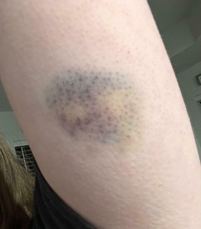 Close-up photo of a bizarre and fascinating bruise on human body skin showing unusual discoloration and texture.