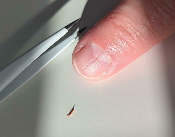 Close-up of a human finger and nail with a small sharp splinter being removed, highlighting bizarre human body details.