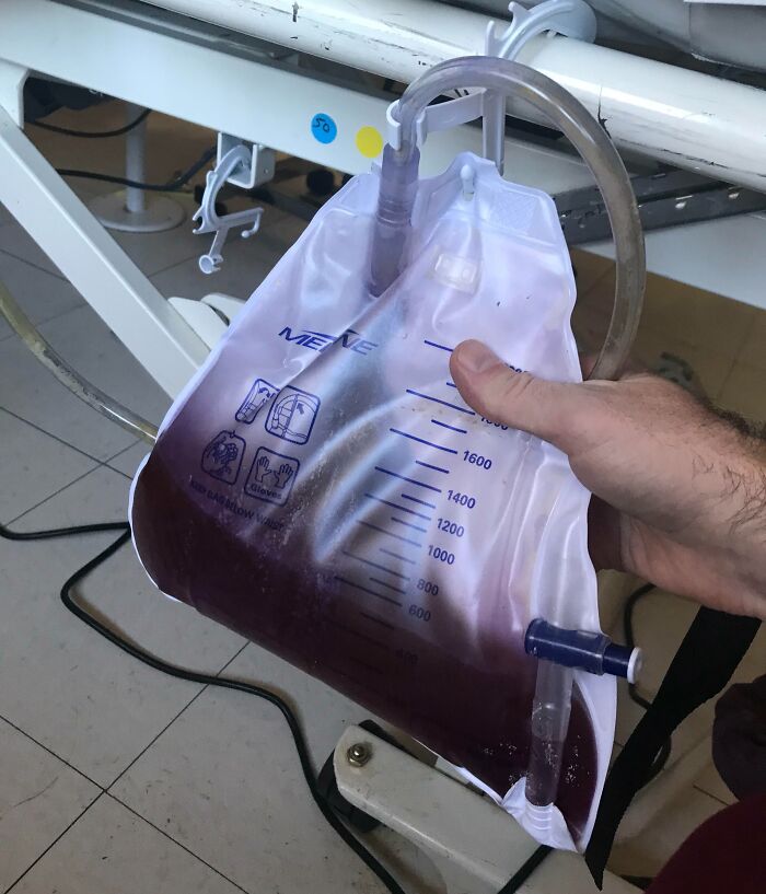 Medical bag filled with dark fluid related to bizarre and fascinating photos of the human body, held by a hand indoors.