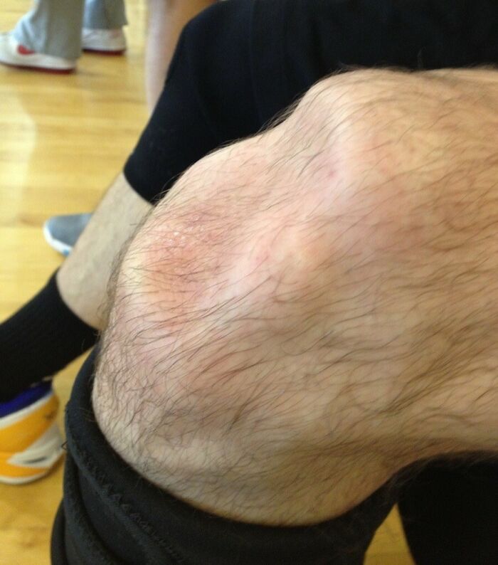 Rodilla humana con cabello visible y ligera inflamación, imagen curiosa del cuerpo humano en un entorno deportivo.