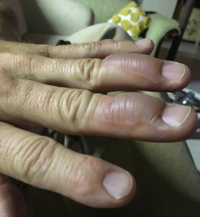 Close-up of human fingers showing unusual swelling and bumps, illustrating bizarre and fascinating human body features.