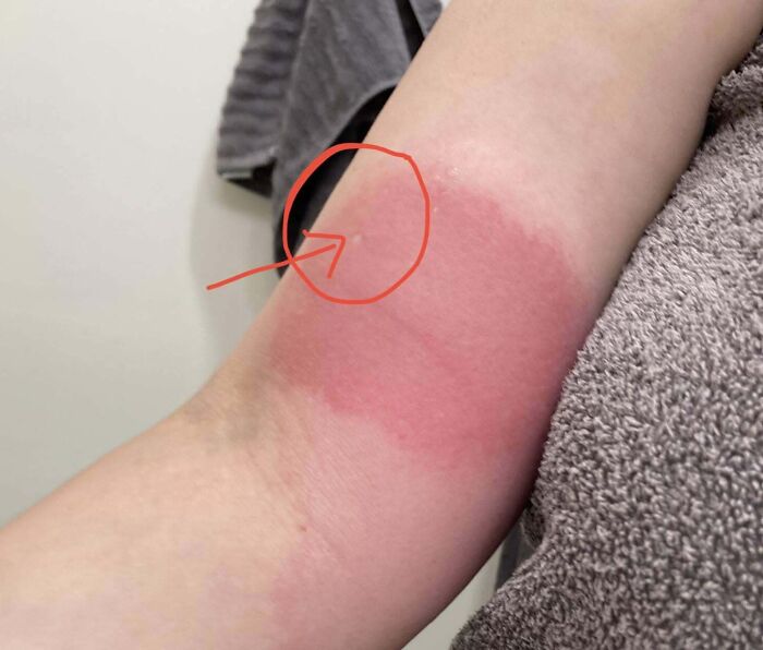 Red irritated skin on human arm with a marked insect bite, showing a bizarre and fascinating human body reaction.