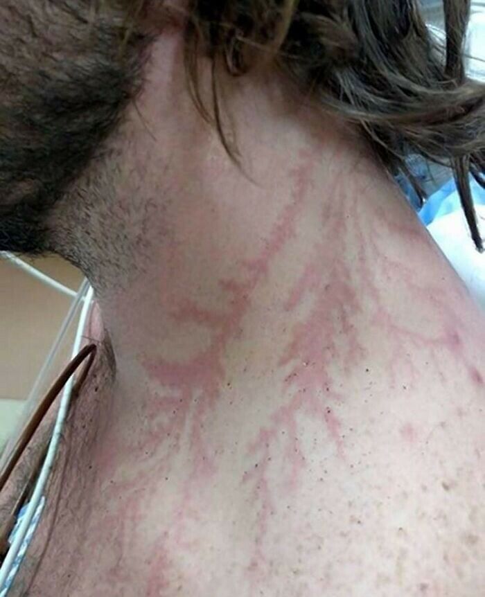 Marcas rojas con forma de venas en el cuello de un hombre, imagen curiosa del cuerpo humano mostrando reacciones en la piel.