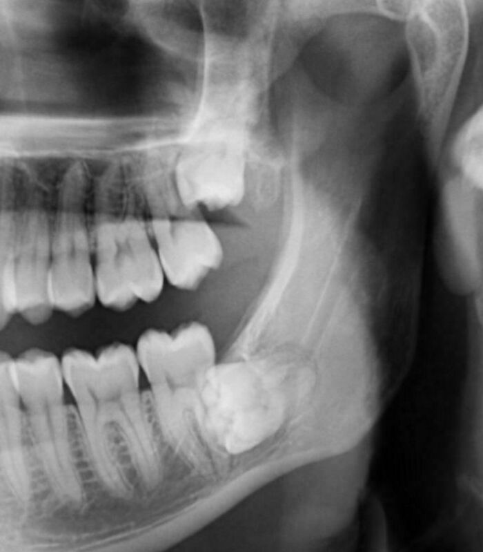 Radiografía dental que muestra muelas del juicio impactadas, imagen interesante del cuerpo humano para estudio odontológico.