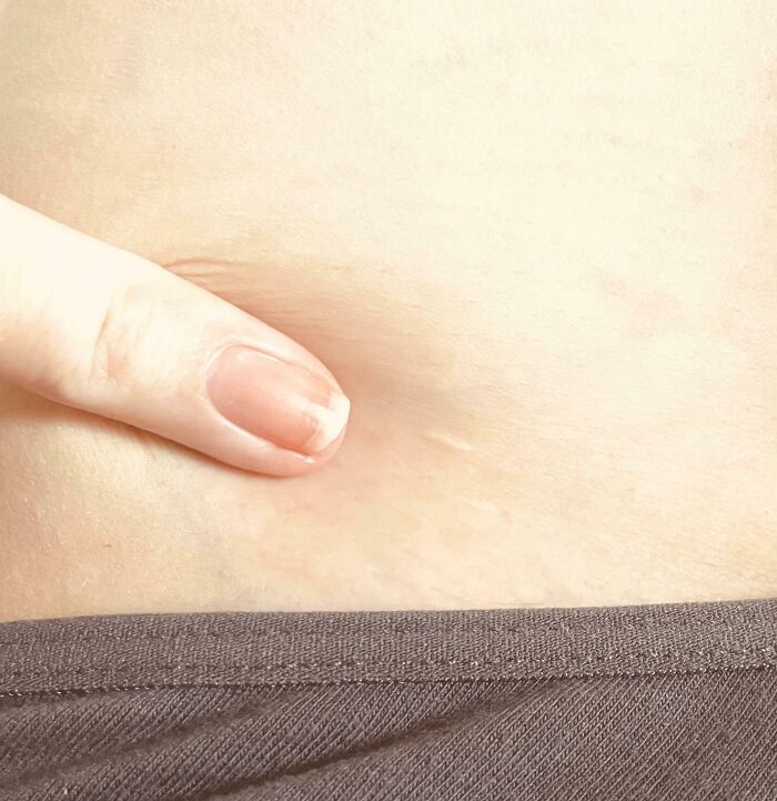 Close-up of a finger pointing at a small scar on human skin, highlighting an unusual aspect of the human body.