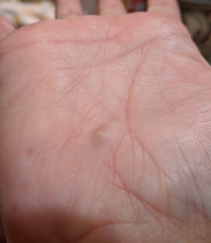 Close-up of a human palm showing skin texture and a small raised bump, highlighting unusual details of the human body.