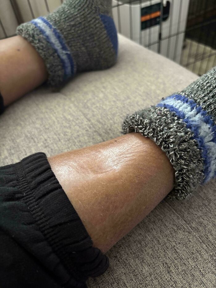 Close-up of human body lower leg and ankle with textured skin and wool socks resting on a fabric surface.