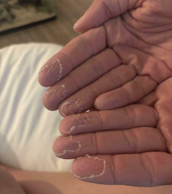 Manos con piel descamada mostrando detalles interesantes y curiosos del cuerpo humano en primer plano.