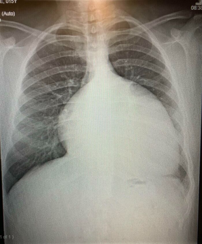 Radiografía del tórax humano mostrando costillas, pulmones y corazón, destacando curiosidades del cuerpo humano.