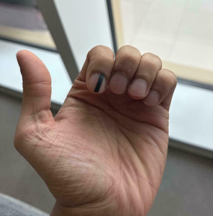 Close-up of a human hand showing a bizarre black vertical line on one fingernail, highlighting unusual human body traits.
