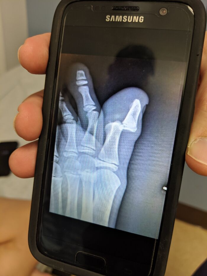 Radiografía en pantalla de móvil mostrando huesos rotos del dedo, ilustrando padres y madres teniendo un día peor.